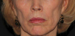 Sculptra-Lower Face Before